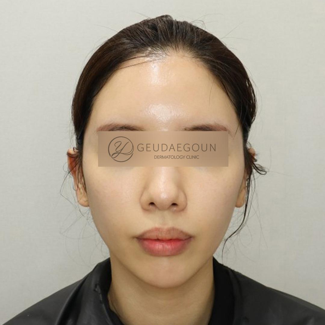 Después del tratamiento Titanium Lifting (Soprano Titanium)