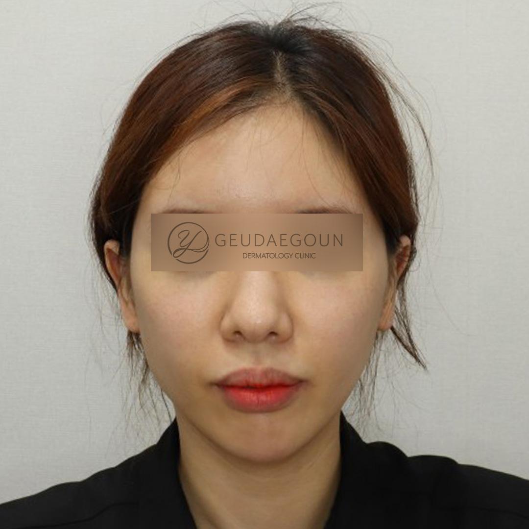 Antes del tratamiento Titanium Lifting (Soprano Titanium)