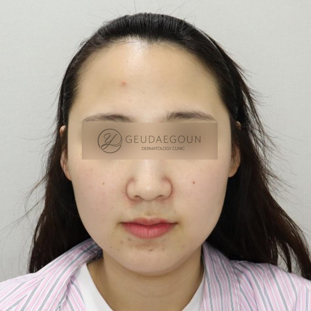 Antes del tratamiento Ulthera + Thermage