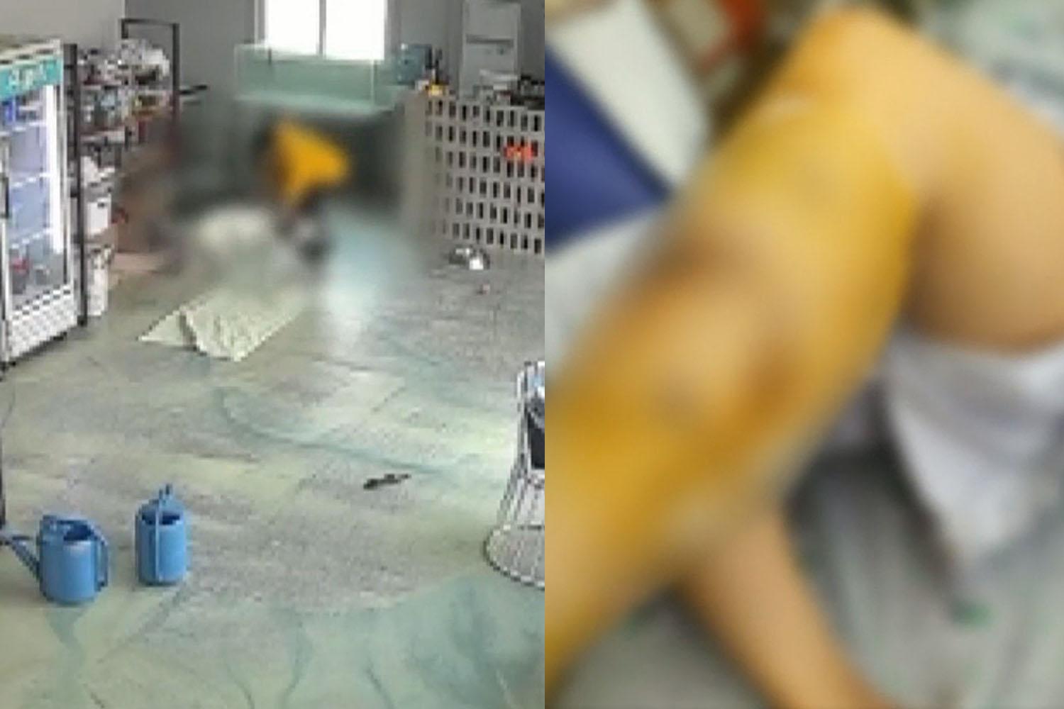  จนต้องเข้ารับการผ่าตัดถึง 6 ครั้ง