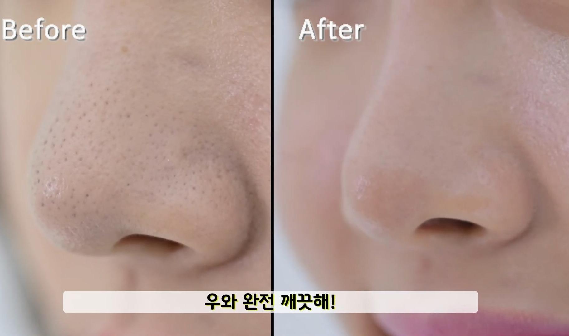 사용黑頭卸妝棒後鼻子清潔效果，皮膚乾淨無瑕。