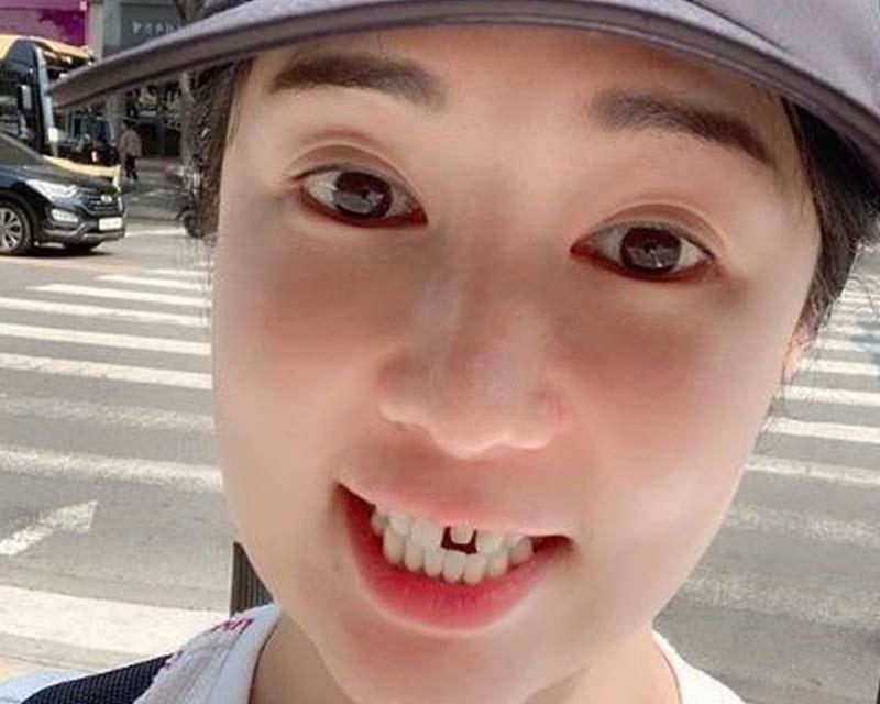 Sayuri Fujita กับการติดวีเนียร์ที่ฟัน