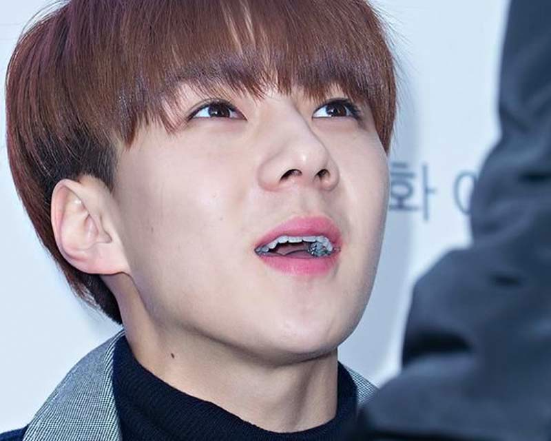 เซฮุน EXO สวมเหล็กดัดฟัน