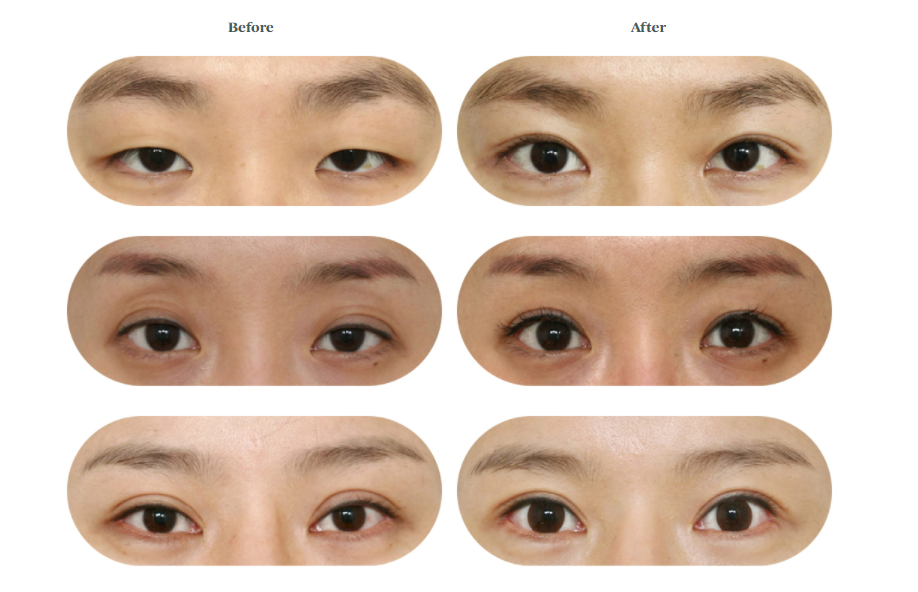 Perbandingan sebelum dan sesudah operasi kelopak mata non-insisi di Klinik Bedah Plastik Wonjin.
