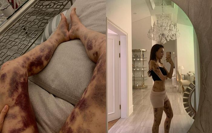 健康注射の副作用により全身にあざができたAORIの全身写真、日本の有名人による健康リスクの公表