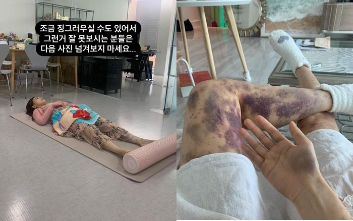 健康注射を受けた後、重度の皮膚反応を示すAORIの足、日本のインフルエンサーの健康に関するエピソード