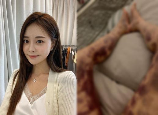 ｢健康注射｣を打ったYouTuber、体中が血あざだらけ…「病院が怒鳴った」