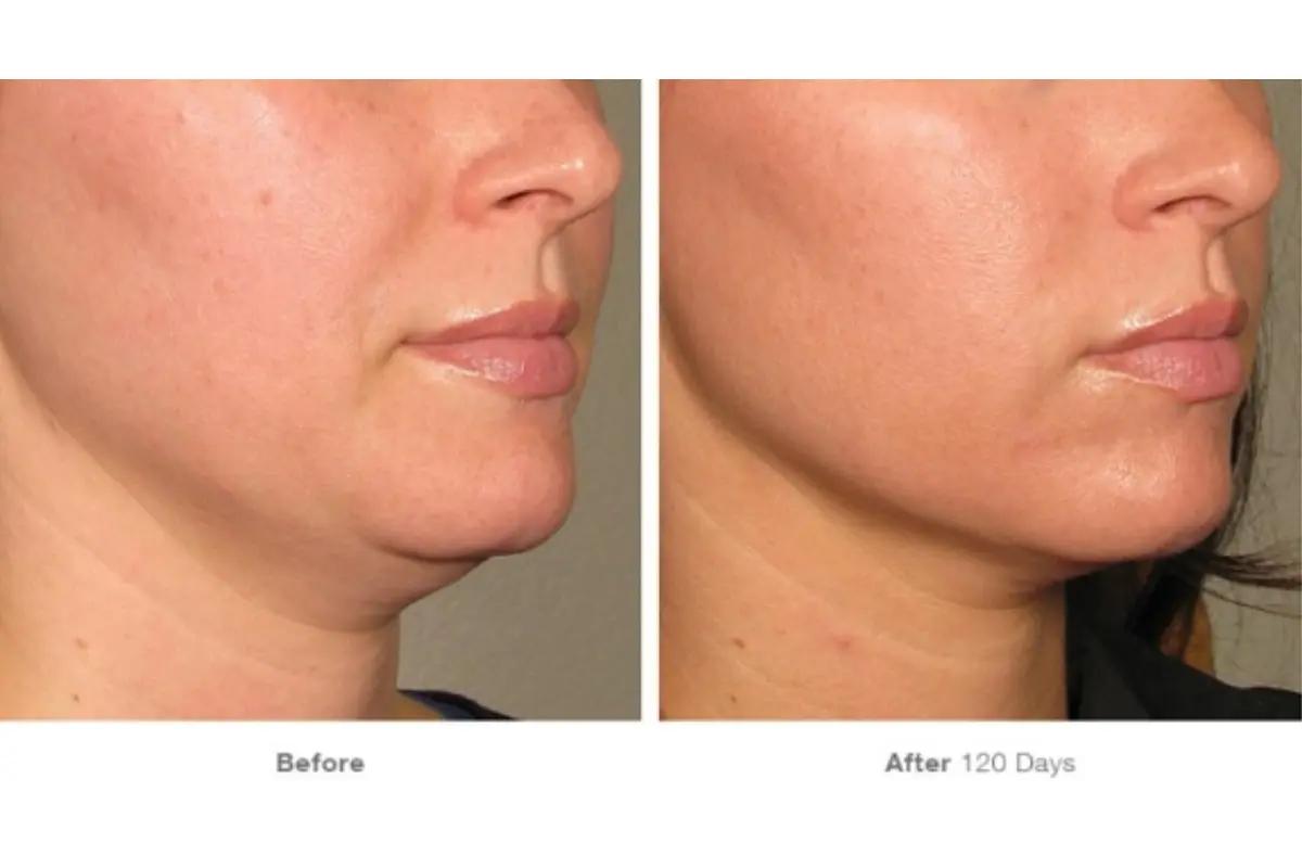 韓国ソウル江南区のJIWOOCLINICでの施術例のビフォーアフター写真、曇りガラス加工