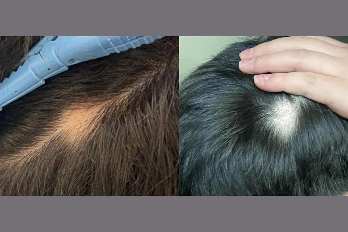 ผลข้างเคียง