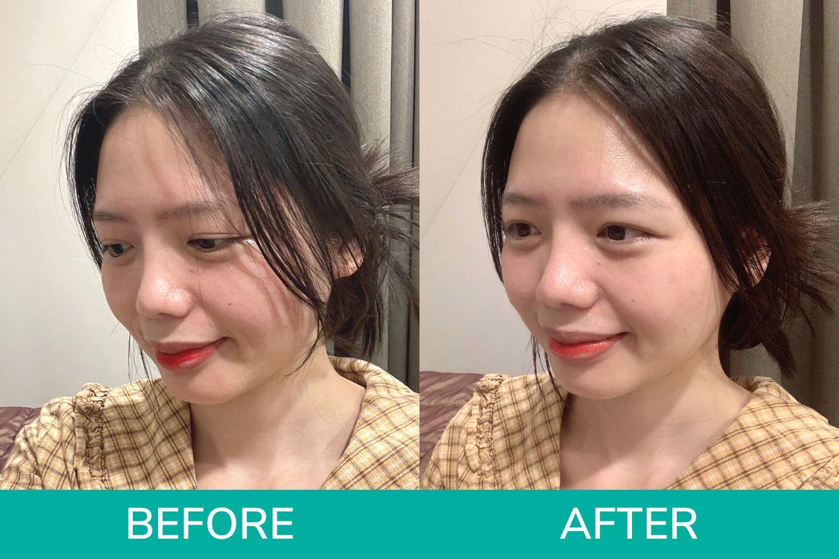 trước và sau khi chăm sóc da tại thẩm mỹ viện WOOA, Gangnam