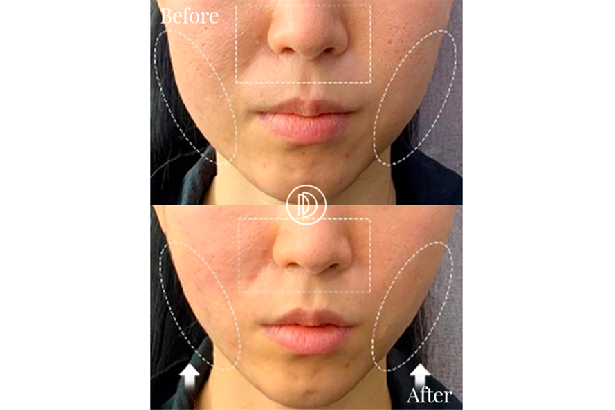 施术前后改善弹力与下巴线条效果图