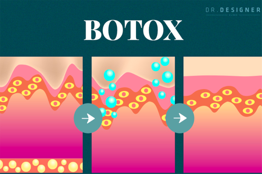 肉毒杆菌面部注射技术的仪器展示图