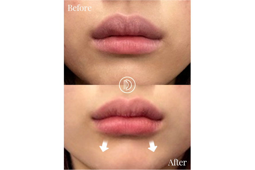 面部玻尿酸填充前后效果展示图，显示年轻化改善