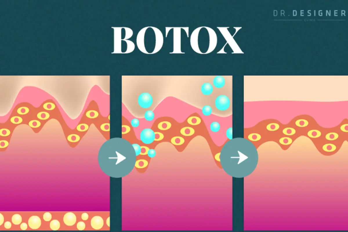 肉毒桿菌注射海報，減少動態性皺紋和改善多汗症