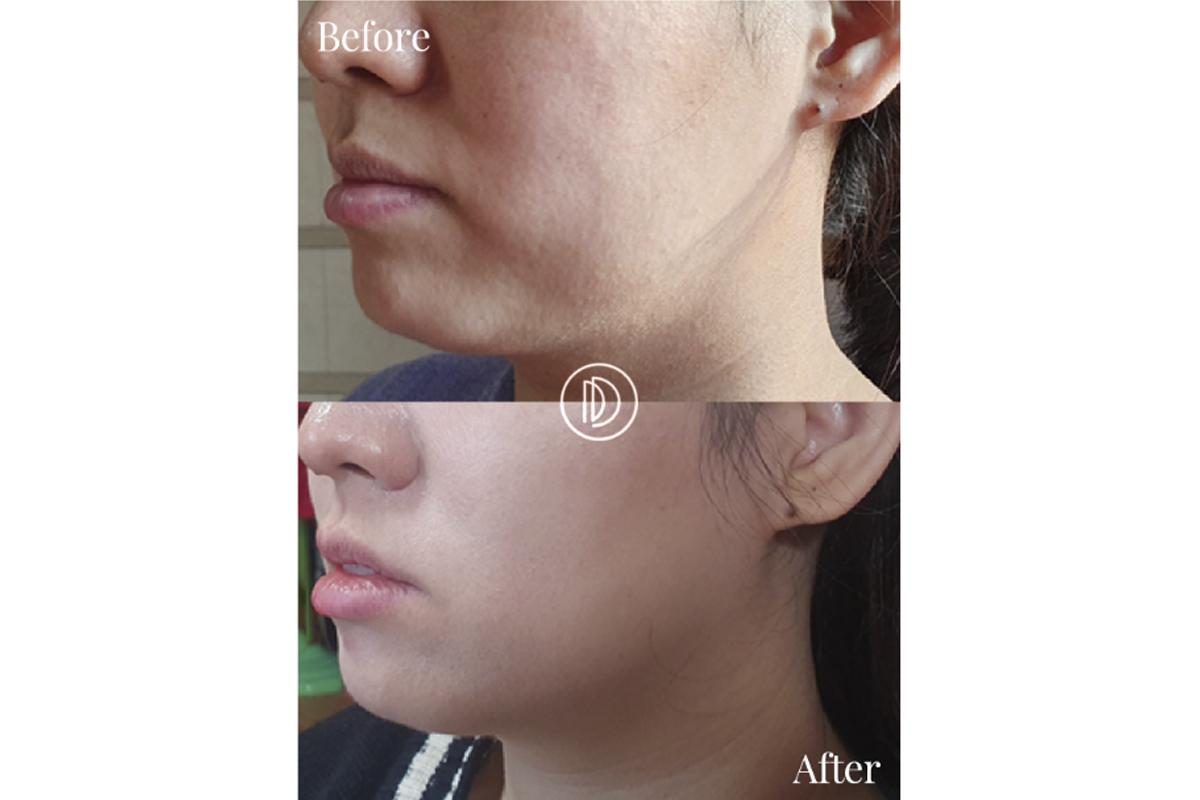 弘大 DR. DESINGER 弘大皮膚科 ソウル 韓国美容 韓国 韓国旅行 韓国美容旅行 女神チケット ボトックス フィラー 水光注射 シュリンクユニバース リフトアップ ニキビ改善 美白クリニック アクアピール ウルセラ ピーリング