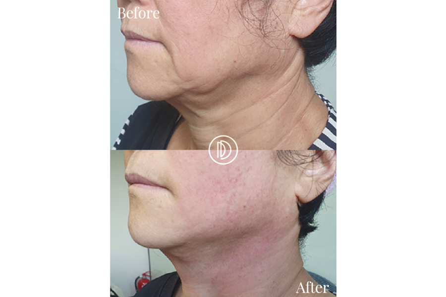 面部提拉前后效果对比图，显示了结果效果