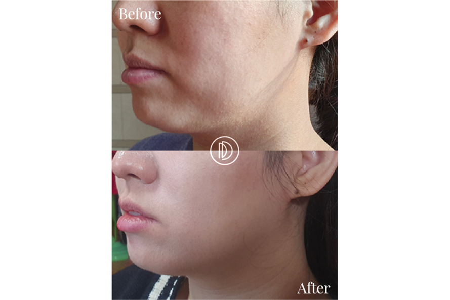 脸部V线提拉前后效果展示图，显示术后改善