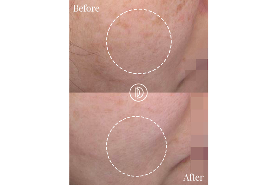 雀斑与肤色改善前后效果展示图，显示色素沉淀的减少