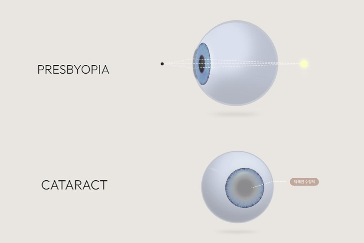韓国旅行 韓国美容 韓国眼科 韓国ラシック 韓国ラセック HEALYNG 眼科 江南 ソウル