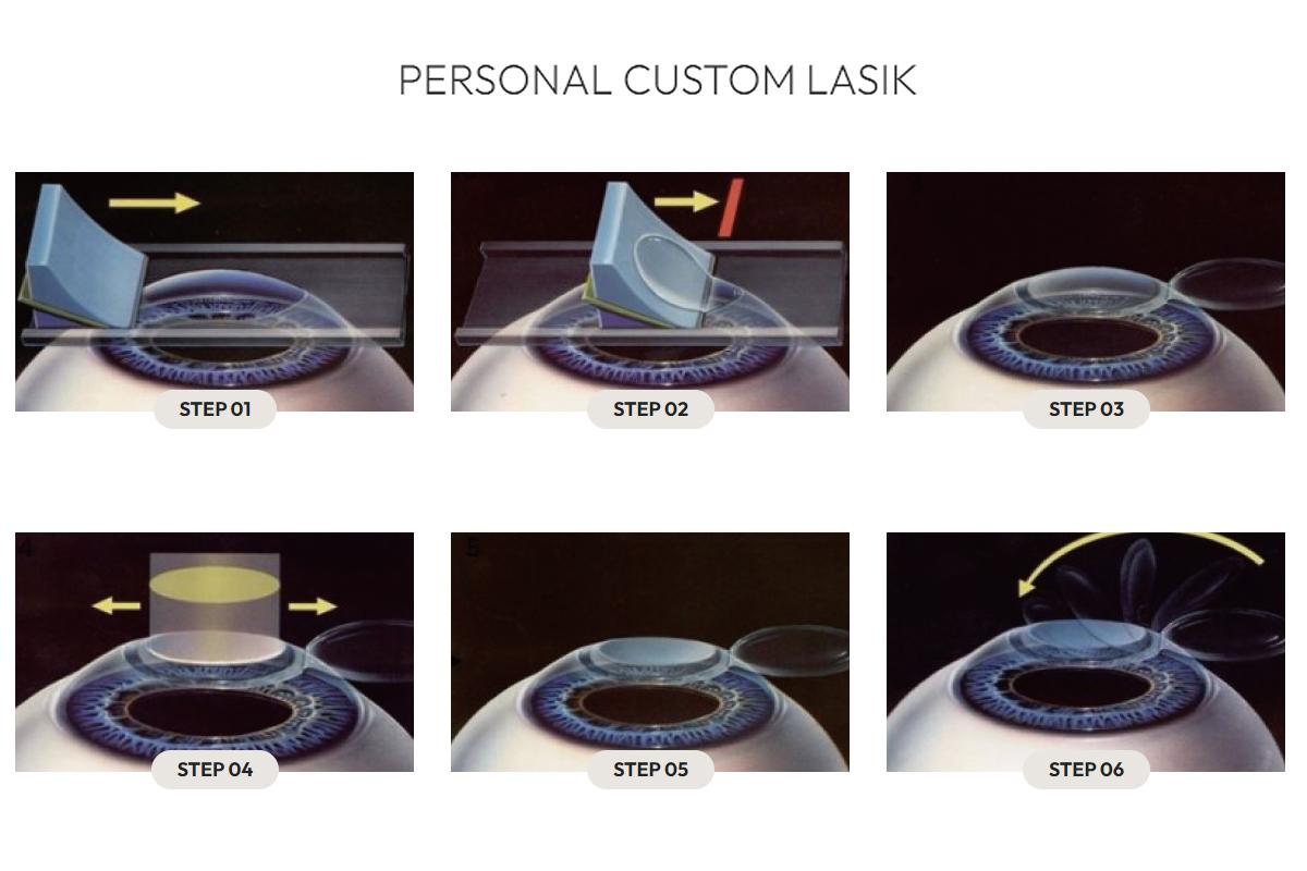 韓国旅行 韓国美容 韓国眼科 韓国ラシック 韓国ラセック HEALYNG 眼科 江南 ソウル