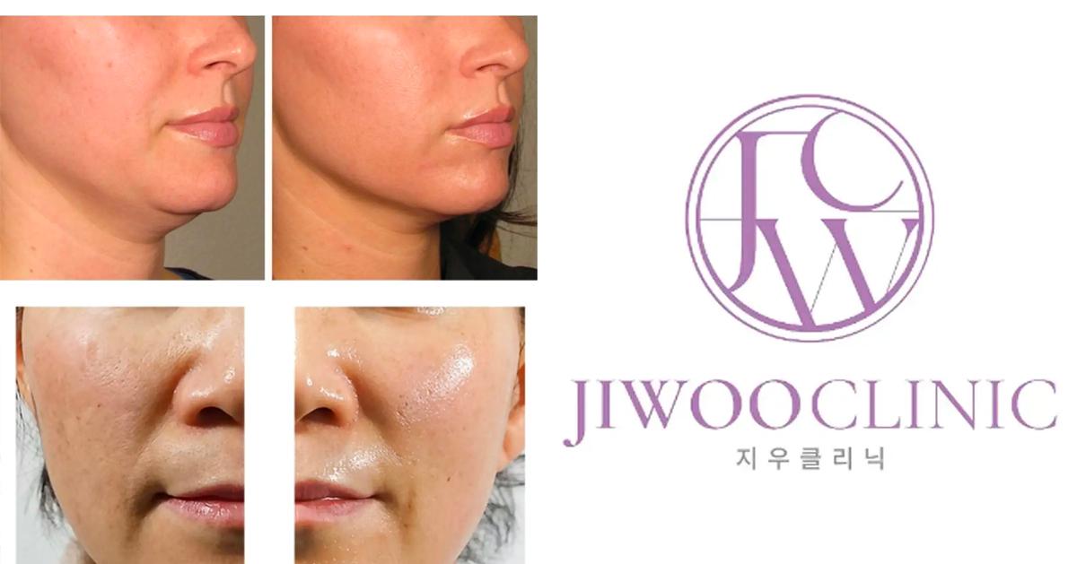 皮膚管理/音波拉提｜Jiwoo Clinic(江南)