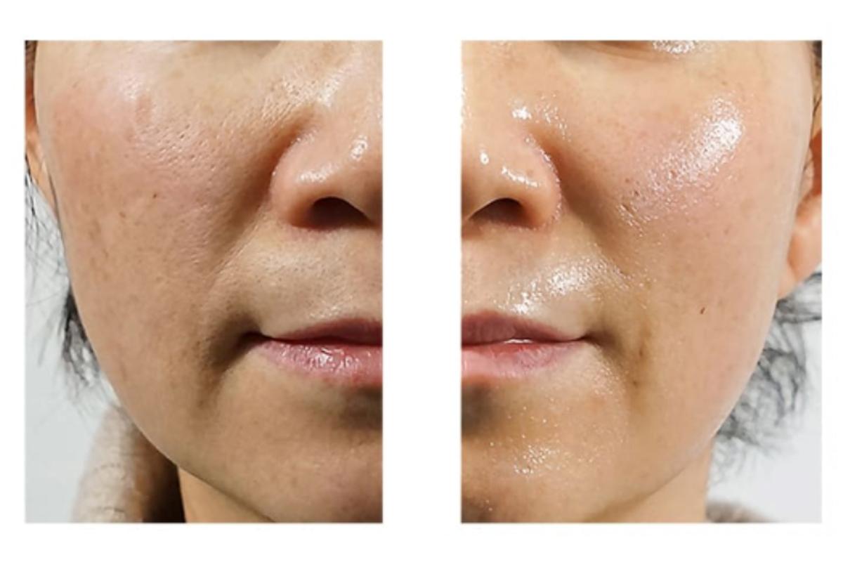 韓国旅行 韓国美容 韓国皮膚科 韓国スキンケア JIWOOCLINIC ソウル 江南 韓国美容旅行