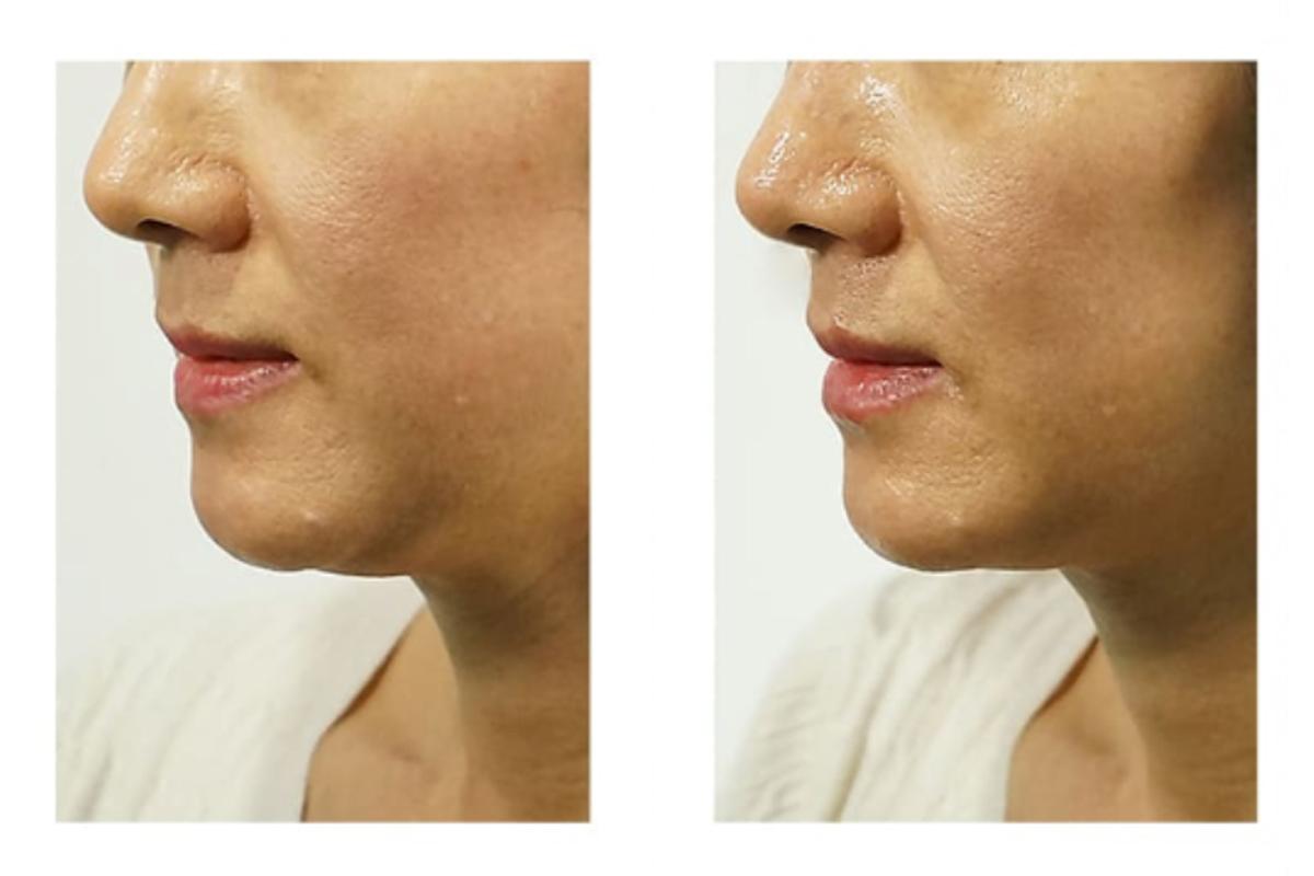 韓国旅行 韓国美容 韓国皮膚科 韓国スキンケア JIWOOCLINIC ソウル 江南 韓国美容旅行