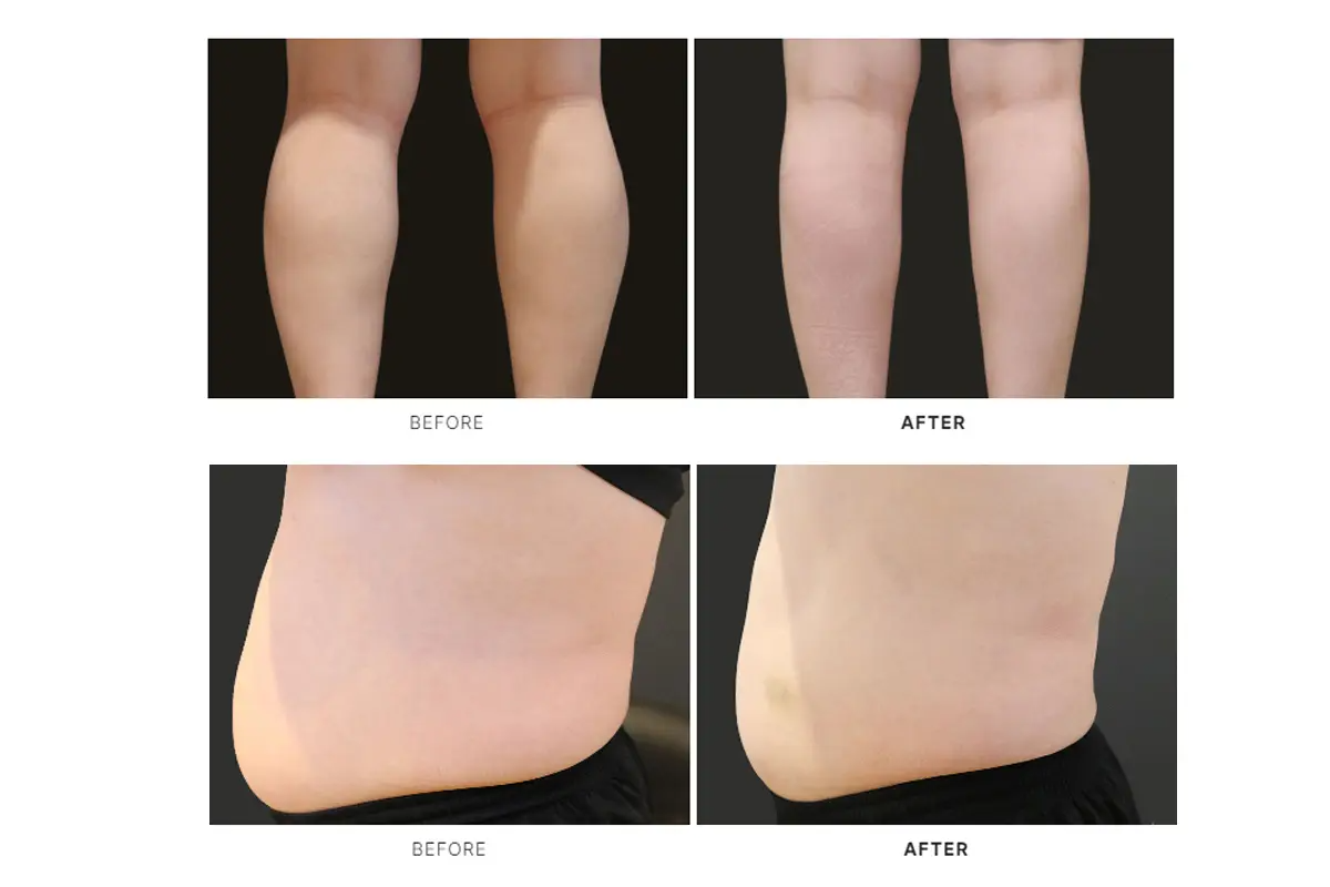 韓國美容 韓國美容中心 江南美容 江南美容中心 LE SHINE CLINIC 身體肉毒桿菌 膊頭 小腿 手臂