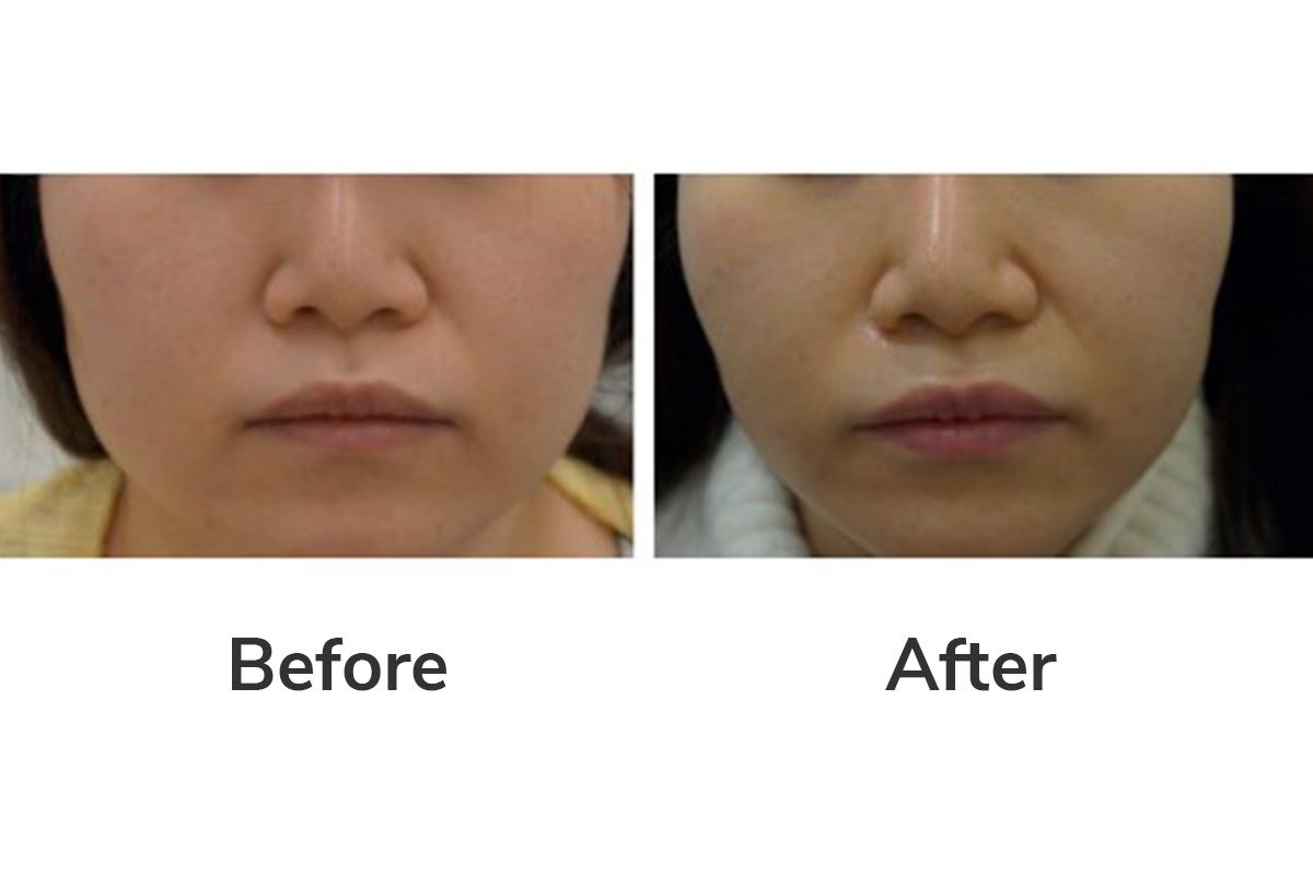 韓國美容 明洞美容中心 韓國護膚療程 韓國減肥療程 韓醫護膚 韓醫減肥 慶熙梅花鹿韓醫院