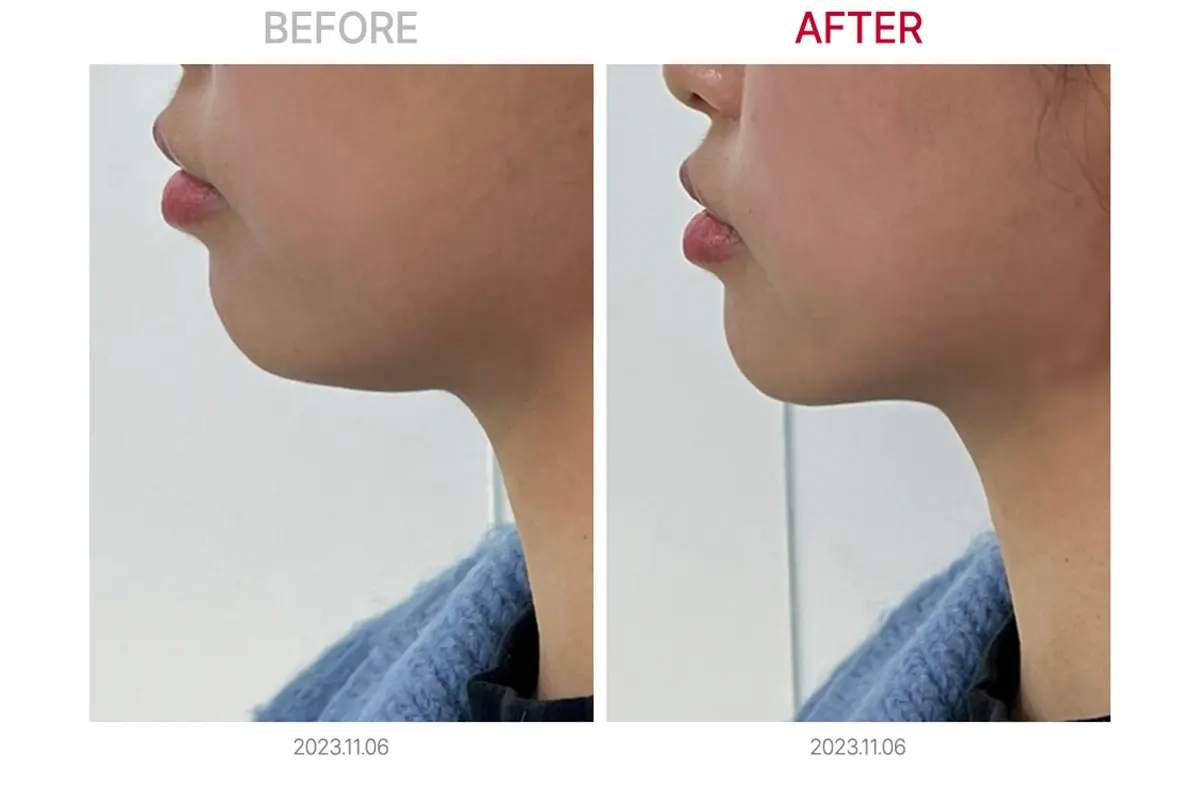 比較圖表顯示LDM、Airjet、再生光療治療的效果。