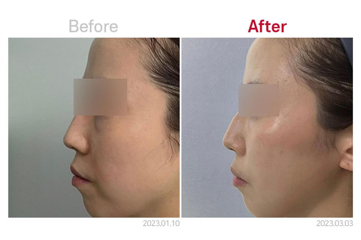 MEDICUBE CLINIC 韓國醫美 音波拉提 江南醫美 新論峴站 江南站醫美 新論峴站醫美 新論峴醫美