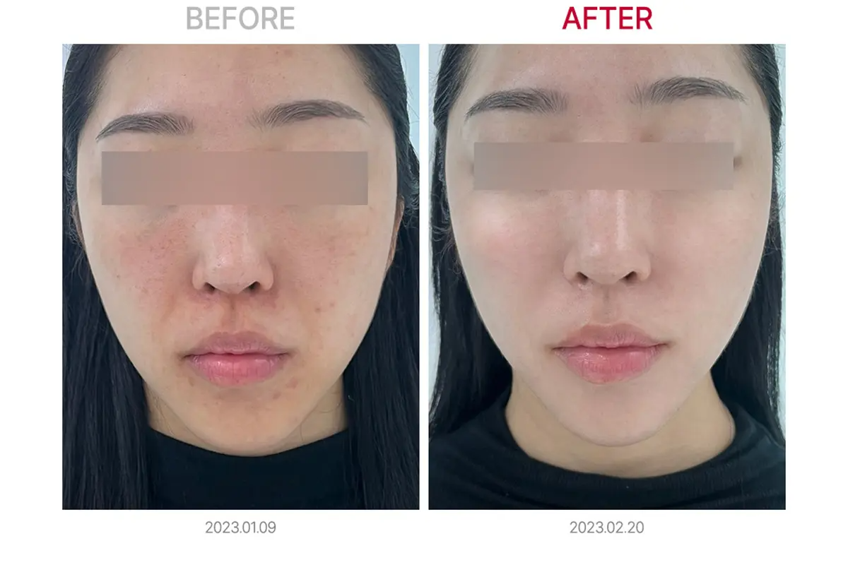 比較圖表顯示Genesis Toning和維他命C離子美白導入的效果。