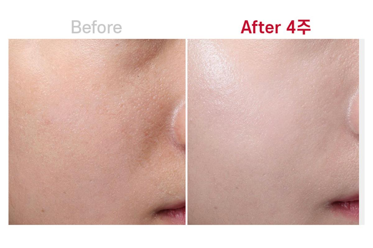 MEDICUBE CLINIC 韓國醫美 音波拉提 江南醫美 新論峴站 江南站醫美 新論峴站醫美 新論峴醫美