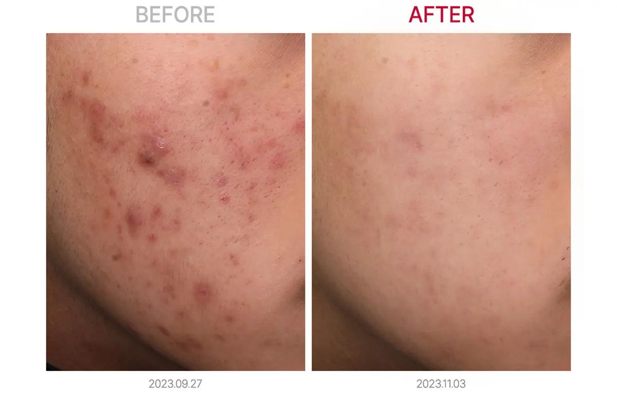 比較圖表顯示TheraClear雷射光療, Capri藍雷射和Cynergy染料雷射治療的效果。