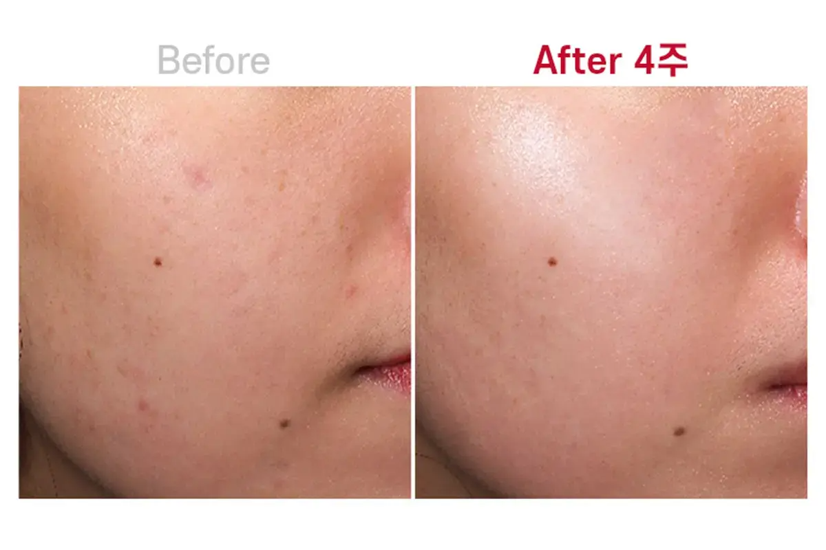 MEDICUBE CLINIC 韓國醫美 音波拉提 江南醫美 新論峴站 江南站醫美 新論峴站醫美 新論峴醫美