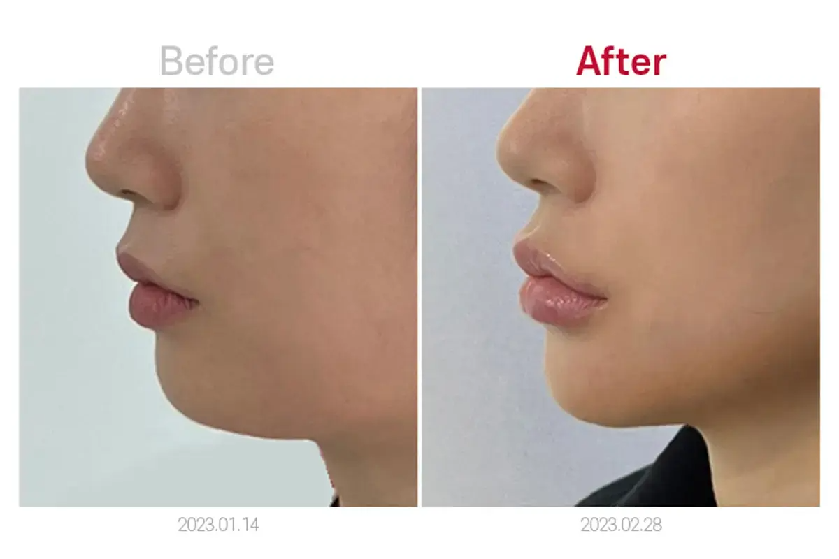 MEDICUBE CLINIC 韓國醫美 音波拉提 江南醫美 新論峴站 江南站醫美 新論峴站醫美 新論峴醫美