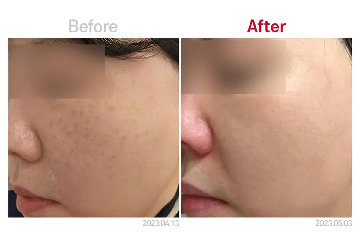 MEDICUBE CLINIC 韓國醫美 音波拉提 江南醫美 新論峴站 江南站醫美 新論峴站醫美 新論峴醫美