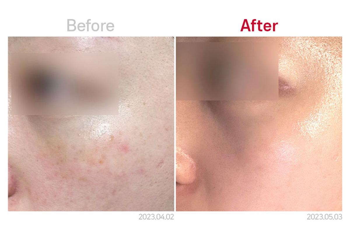 MEDICUBE CLINIC 韓國醫美 音波拉提 江南醫美 新論峴站 江南站醫美 新論峴站醫美 新論峴醫美