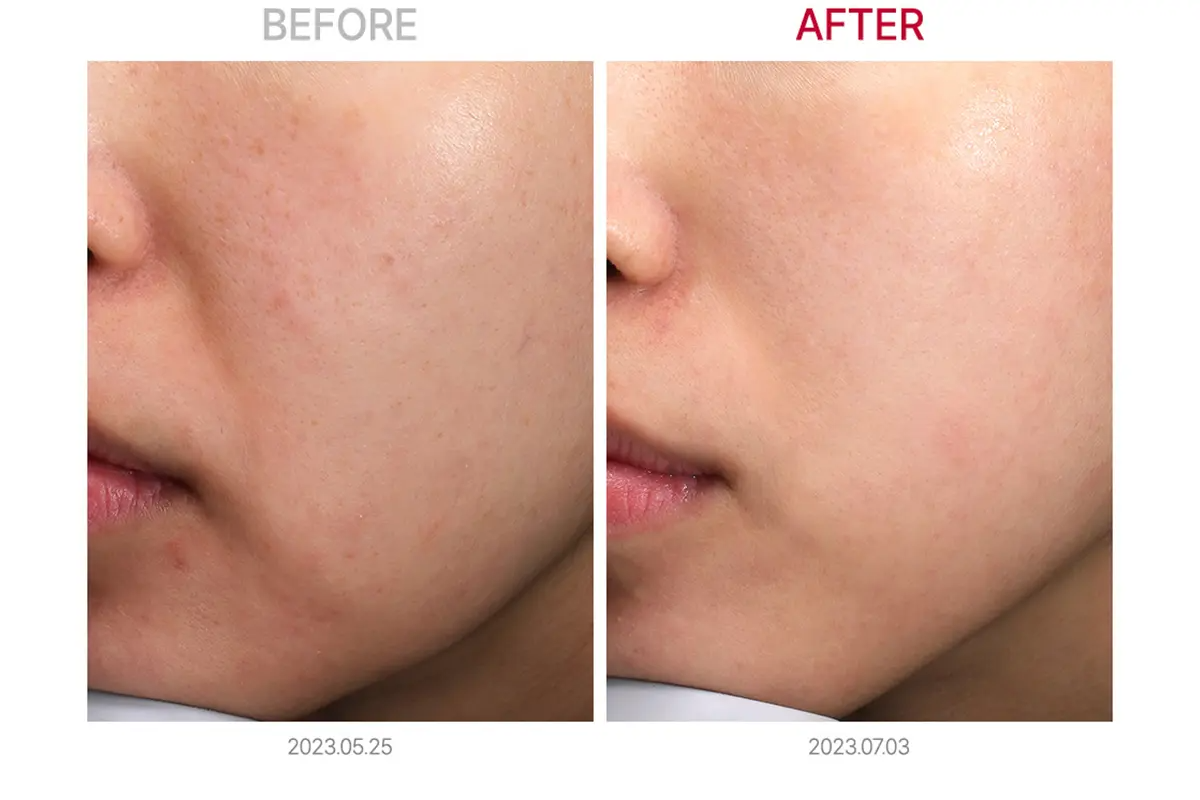 比較圖表顯示伊路達n.core 3D皮膚提拉治療的效果。