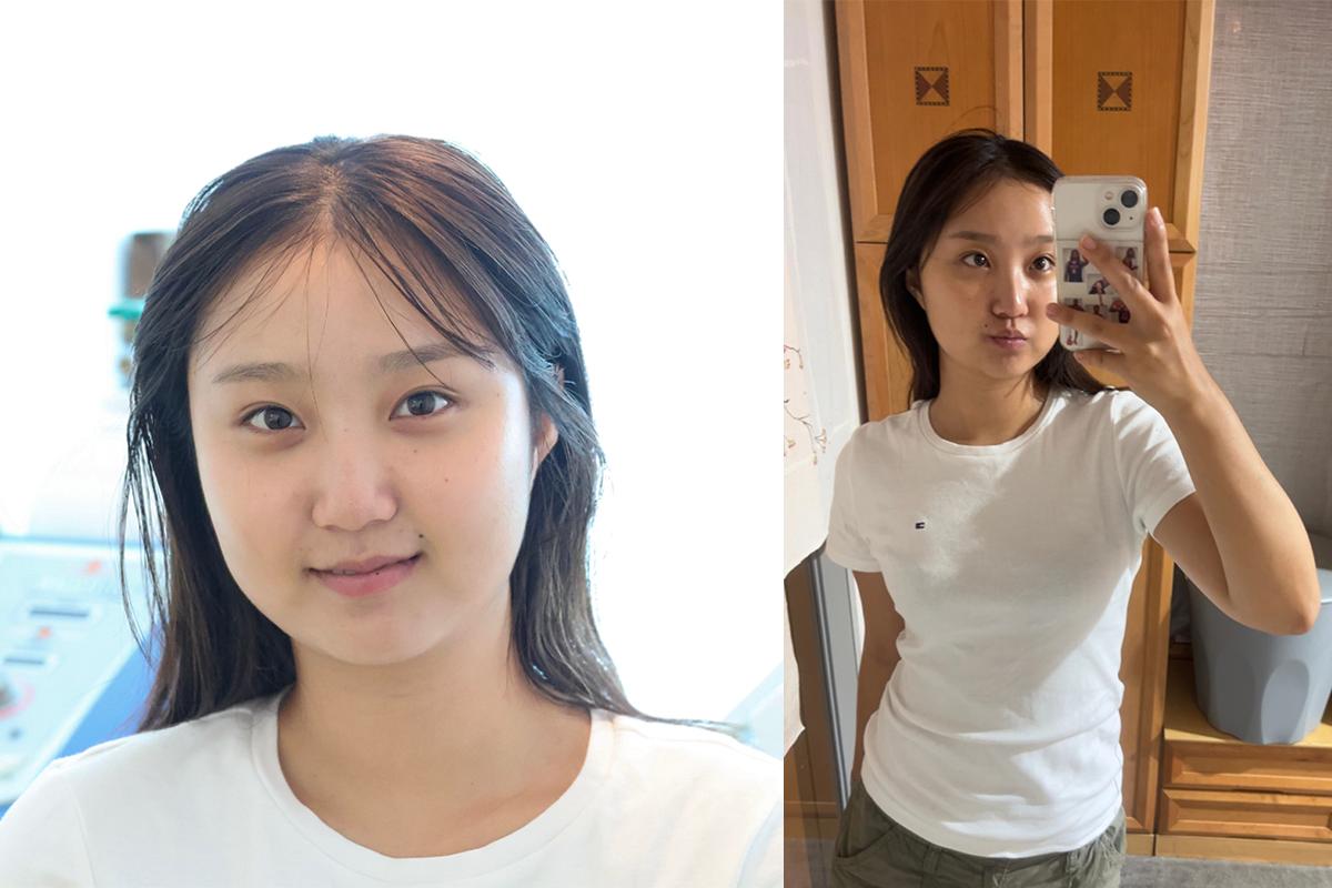 韓國皮膚科 韓國皮膚管理 拉提 皮膚診所 弘大醫美 皮膚拉提 肌膚拉提 護膚 弘大拉提 弘大皮膚管理 韓國醫美