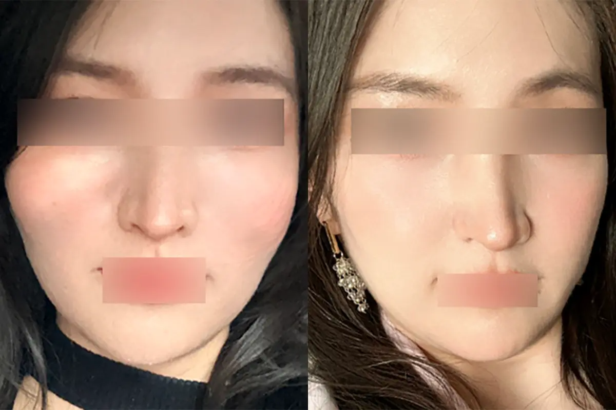 韓國美容 韓國醫美 拉提療程 溶脂針 減肥 江南 PLANS CLINIC 顴骨溶脂針 價錢 效果