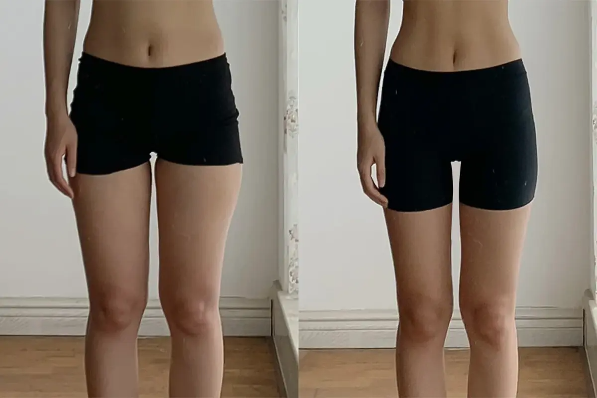 韓國美容 韓國醫美 拉提療程 溶脂針 減肥 江南 PLANS CLINIC 三重激光套餐 三重身體激光 身體溶脂針 減肥藥處方 價錢 效果