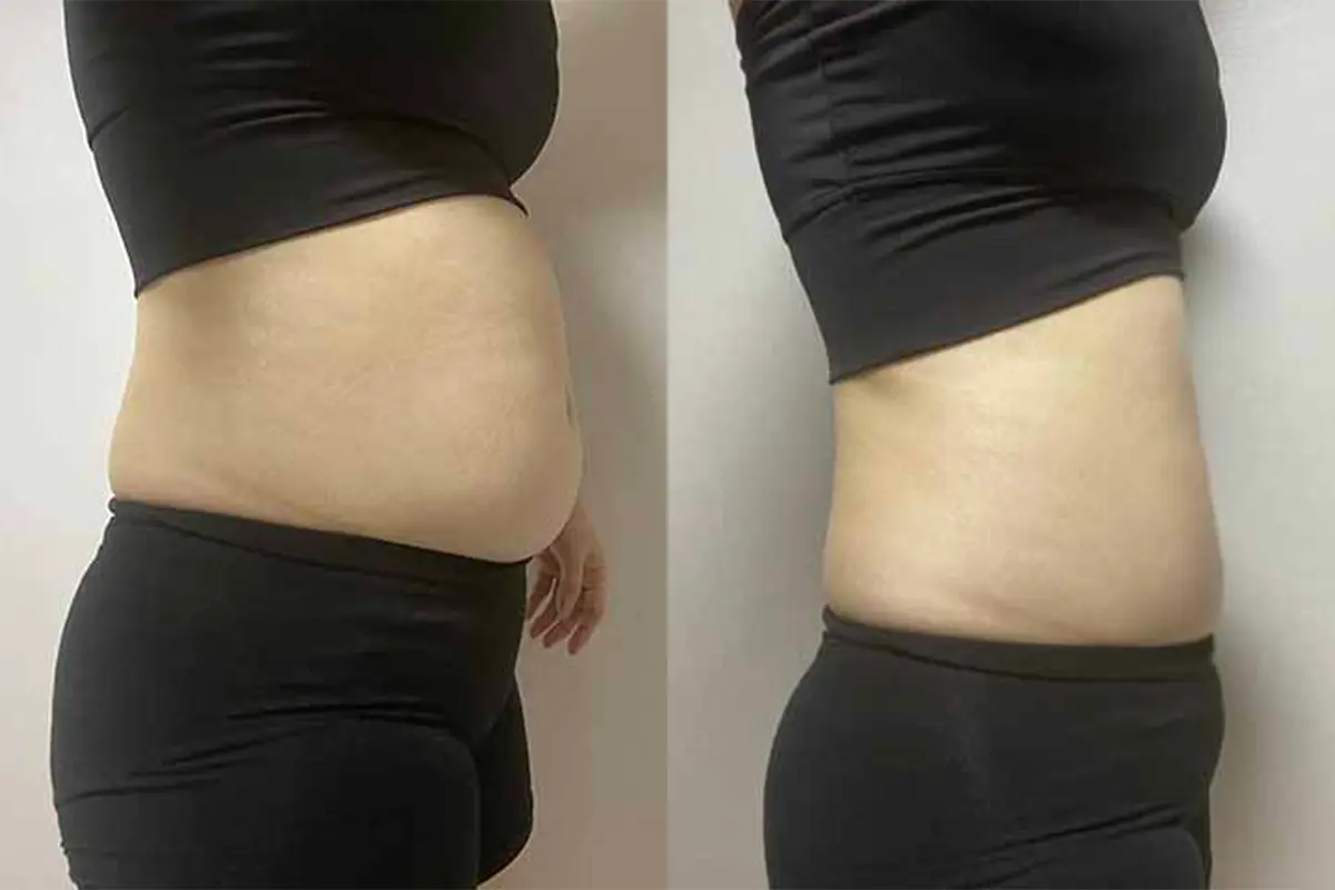 PLANS CLINIC 韓國醫美 江南皮膚管理 韓國拉提 韓國保養 韓國消脂針 韓國溶脂針 鈦金拉提