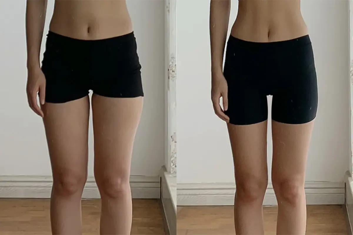 PLANS CLINIC 韓國醫美 江南皮膚管理 韓國拉提 韓國保養 韓國消脂針 韓國溶脂針 鈦金拉提