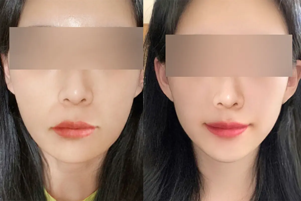 韓國美容 韓國醫美 拉提療程 溶脂針 減肥 江南 PLANS CLINIC 鈦金拉提療程 價錢 效果