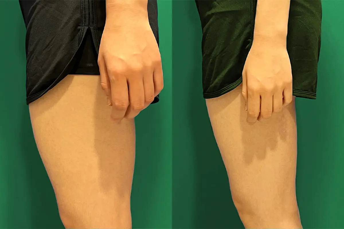 PLANS CLINIC 韓國醫美 江南皮膚管理 韓國拉提 韓國保養 韓國消脂針 韓國溶脂針 鈦金拉提