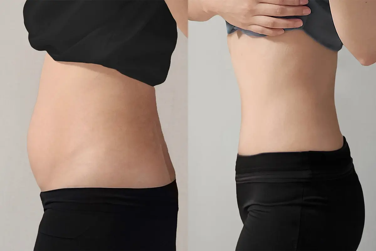 PLANS CLINIC 韓國醫美 江南皮膚管理 韓國拉提 韓國保養 韓國消脂針 韓國溶脂針 鈦金拉提