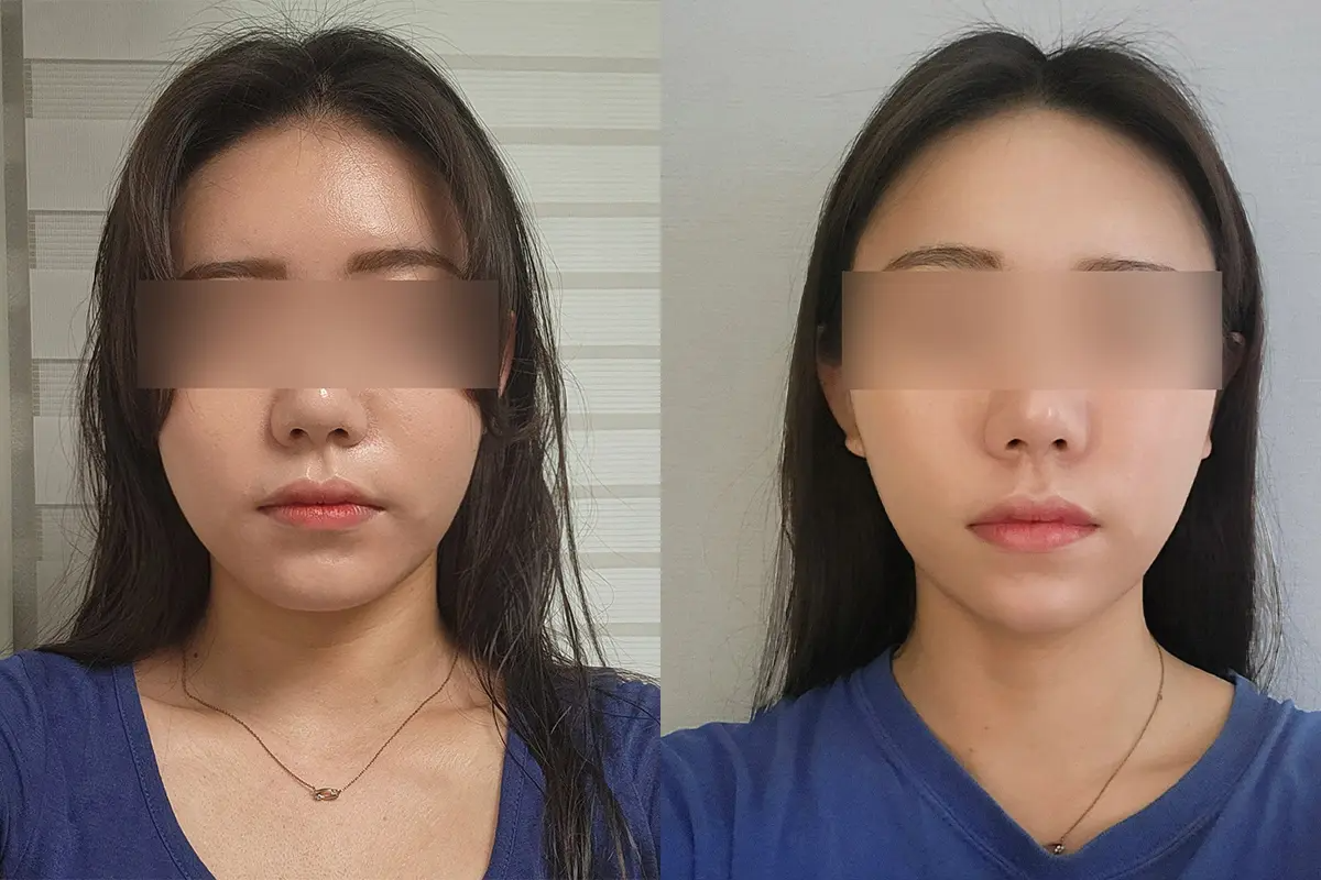 韓國美容 韓國醫美 拉提療程 溶脂針 減肥 江南 PLANS CLINIC 鈦金拉提套餐 鈦金拉提療程 美白激光 V line溶脂針 減肥藥處方 價錢 效果