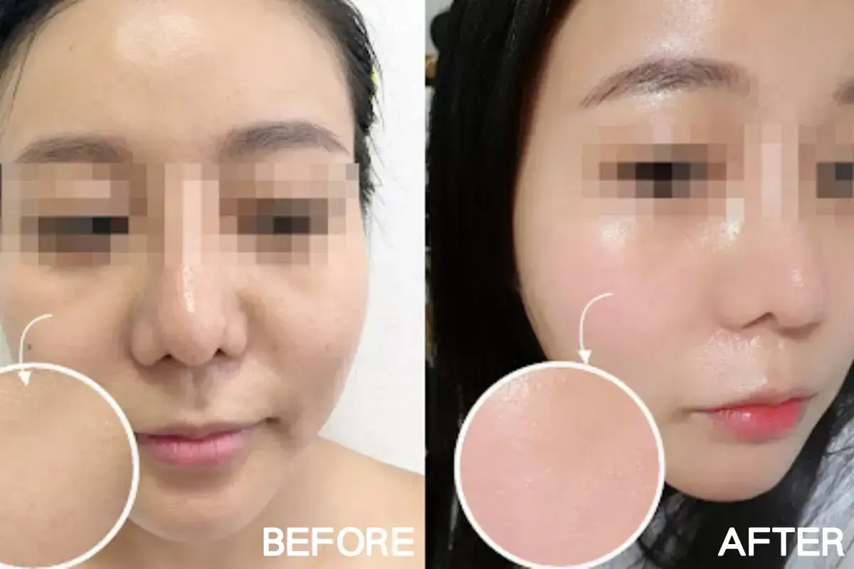 香港人必睇韓國醫美攻略 韓國醫美體驗分享 韓國醫學美容推薦 首爾醫美診所推薦 韓國微整形項目 醫美療程價錢比較 醫學美容口碑評價 韓國皮膚美容雷射 韓國醫美注意事項 韓國醫美流程教學 韓國醫美真實評價 韓國醫美術後護理 韓國醫美價錢透明 首爾醫美預約教學 韓國醫生諮詢重點 韓國醫美熱門療程整理 韓國醫美最新優惠