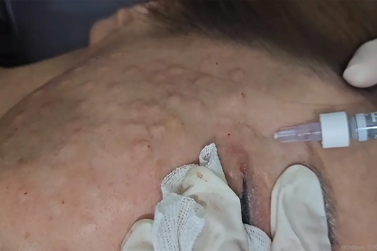 韓國醫美 弘大皮膚管理 皮膚科 美白 音波拉提 弘大入口站 弘大站醫美 弘大站皮膚管理 韓國皮膚管理 韓國拉提 韓國保養 뷰티 弘大醫美 Abijou clinic